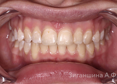 Лечение на съемных пластинках с переходом на брекет-систему