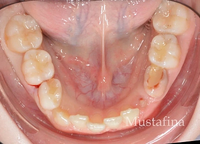 Лечение на элайнерах