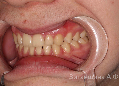 Лечение на брекет-системе