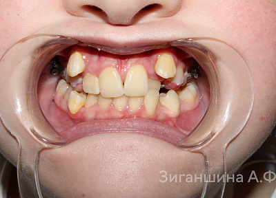 Лечение на брекет-системе