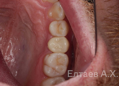 Установка коронки на зуб