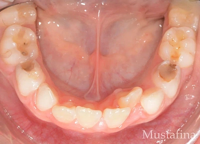 Лечение на элайнерах