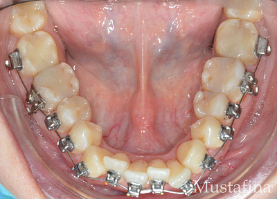 Лечение на брекет-системе – рецессии