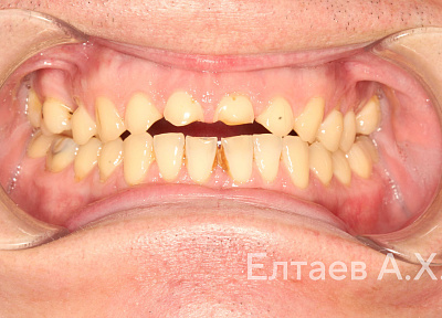 Установка коронок на зубы