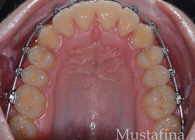 Лечение на брекет-системе – дефицит места