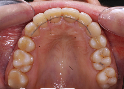 Лечение на брекет системе