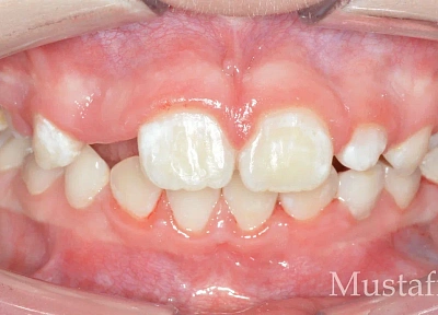 Лечение на элайнерах