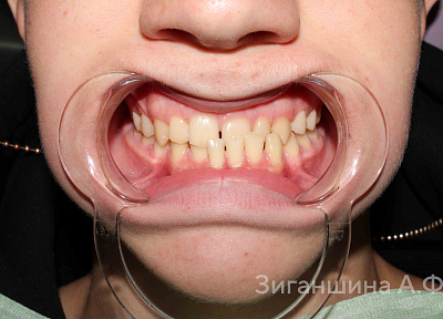 Лечение на брекет-системе