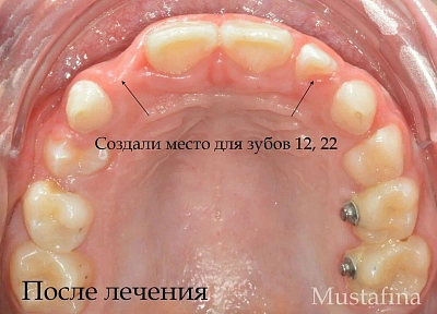 Лечение на элайнерах