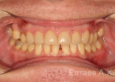 Установка коронок на зубы