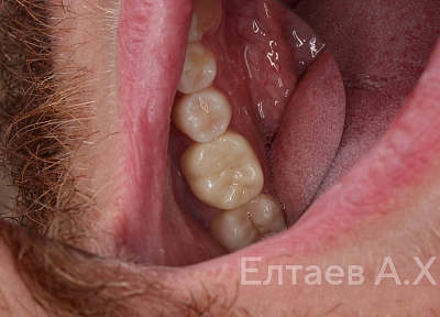 Установка коронки на зуб