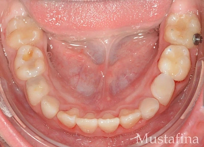 Лечение на элайнерах