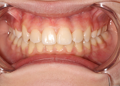 Исправление прикуса брекетами