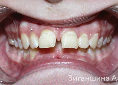 Лечение на съемных пластинках с переходом на брекет-систему