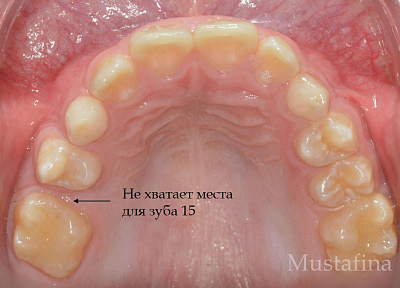 Лечение на брекет-системе – дефицит места