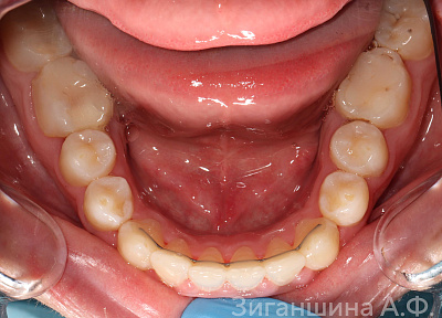 Лечение на брекет-системе