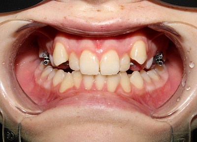 Лечение на аппарате для расширения верхнего зубного ряда с переходом на брекет-систему