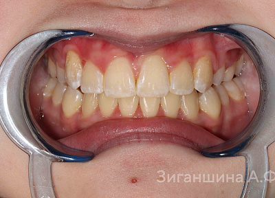 Лечение на брекет-системе