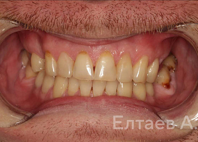 Виниры в зоне улыбки, боковые коронки на зубы