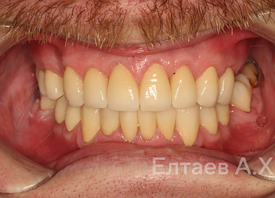 Виниры в зоне улыбки, боковые коронки на зубы