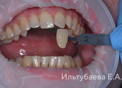 Отбеливание зубов