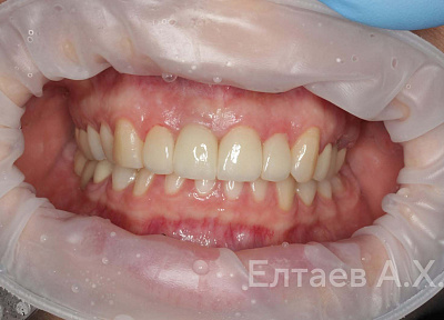 Виниры и коронка на имплант