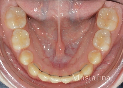 Лечение на элайнерах